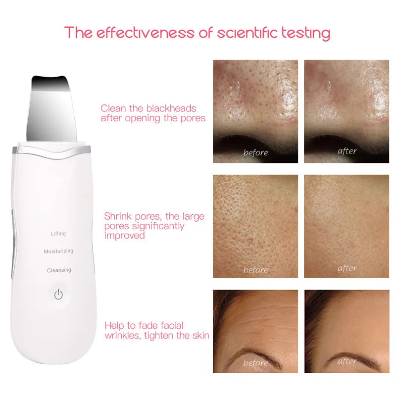 3-in-1 Ultrasonic Facial Skin Scrubber and Pore Cleaner - 8