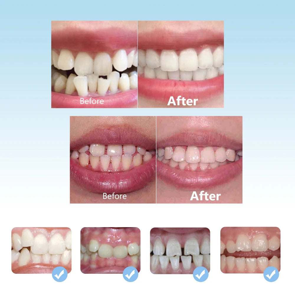 3-Stage Kids Teeth Alignment Trainer and Straightener Set - 12