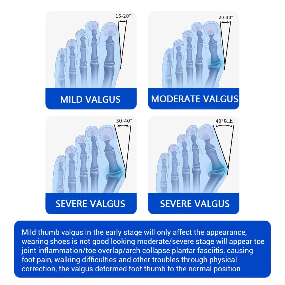 Adjustable Bunion Corrector for Pain Relief and Toe Alignment - 5