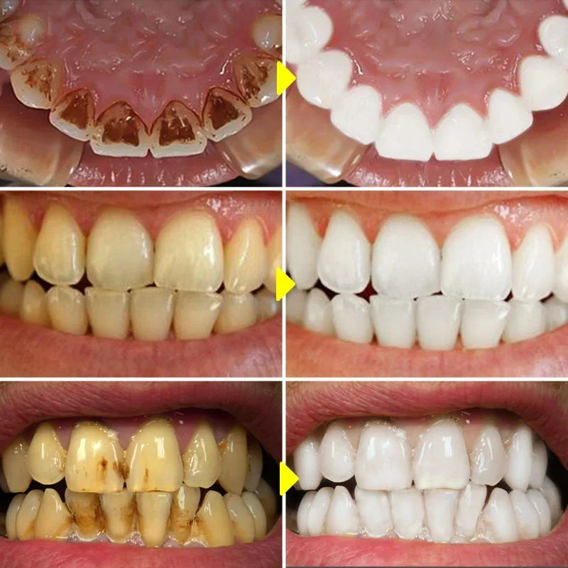 Probiotic Teeth Whitening Toothpaste for Stain Removal - 2