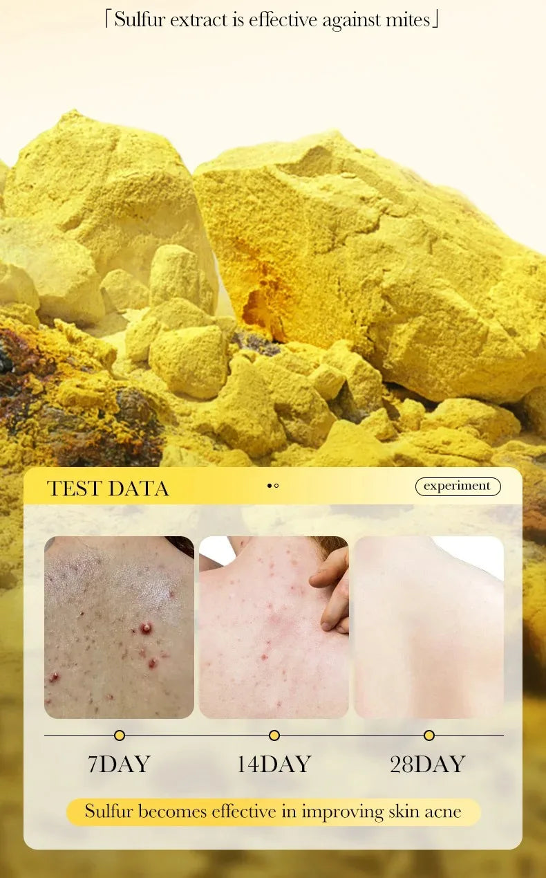 Sulfur Anti-Acne and Mite Removing Facial Soap