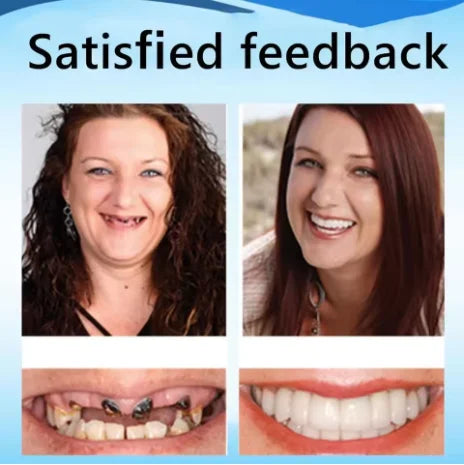 Custom Fit Silicone Cosmetic Dentures - 5