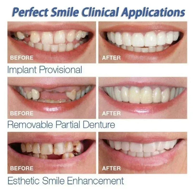Snap-On Instant Smile Veneers for Temporary Teeth Whitening - 4