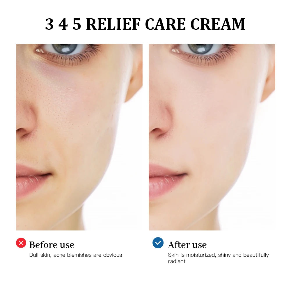 Soothing Repair Facial Cream for Acne-Prone Skin