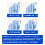 Adjustable Bunion Corrector and Toe Straightener Brace