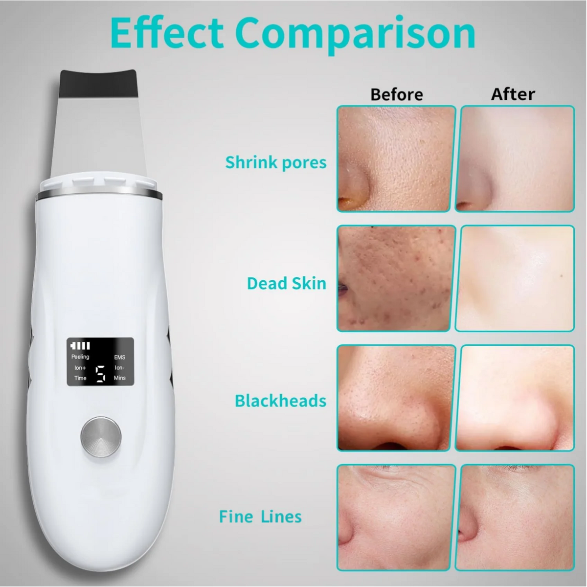 Ultrasonic Facial Skin Scrubber and Pore Cleansing Spatula