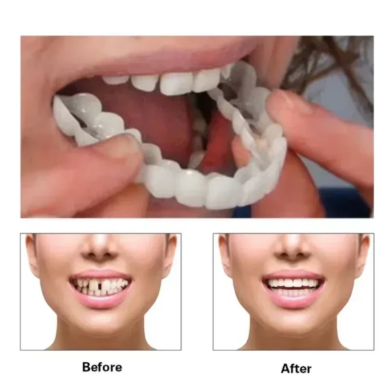 Instant Smile Cosmetic Denture Veneers Set