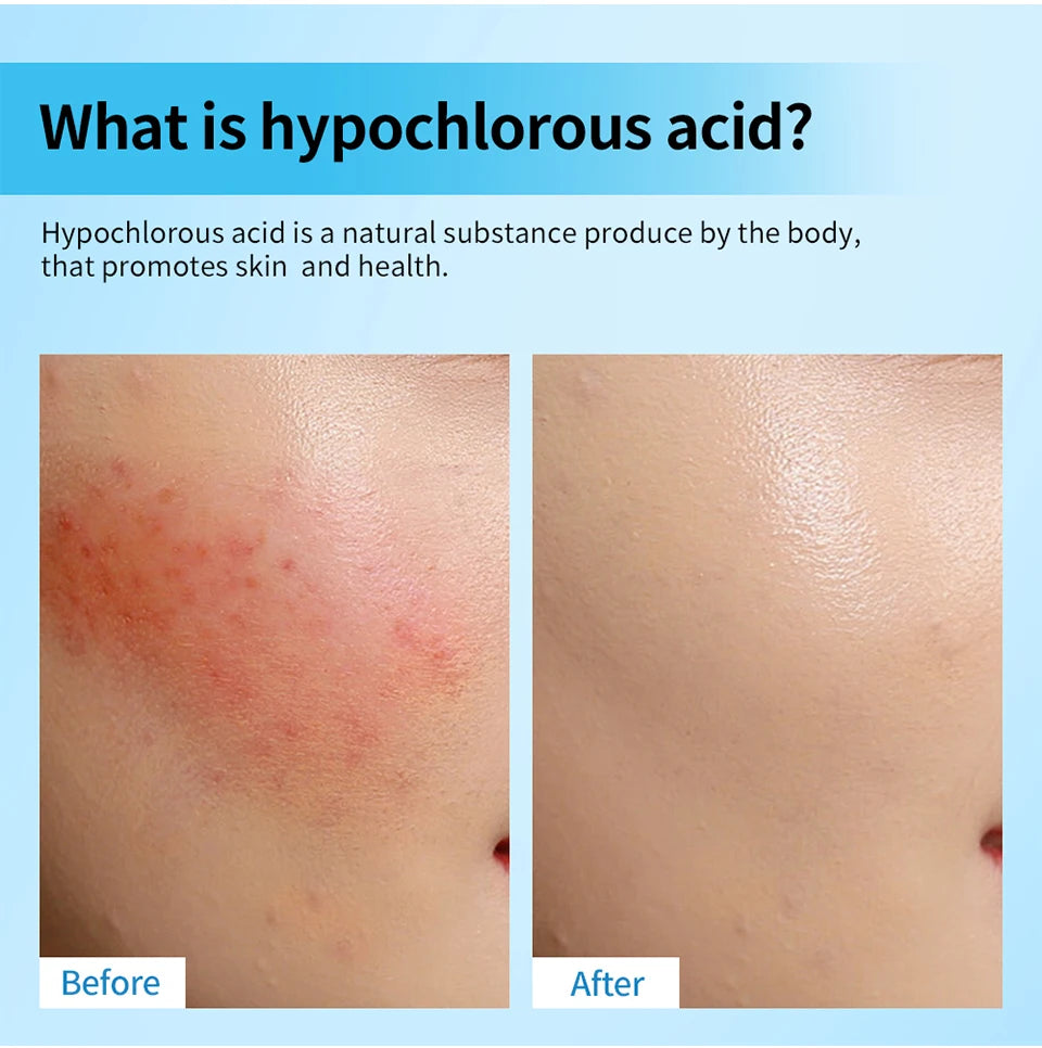 Hypochlorous Acid Soothing Facial Mist for Acne and Redness