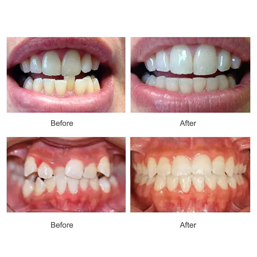 3-Stage Teeth Alignment Orthodontic Mouthpiece for Adults