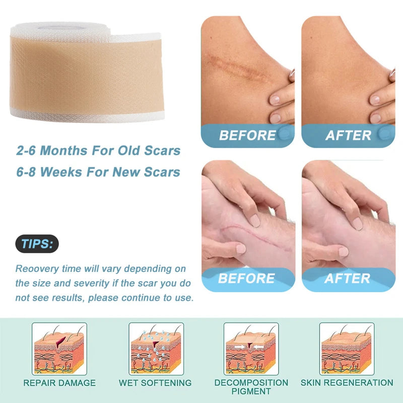 Silicone Scar Removal Tape for Effective Skin Healing - 3
