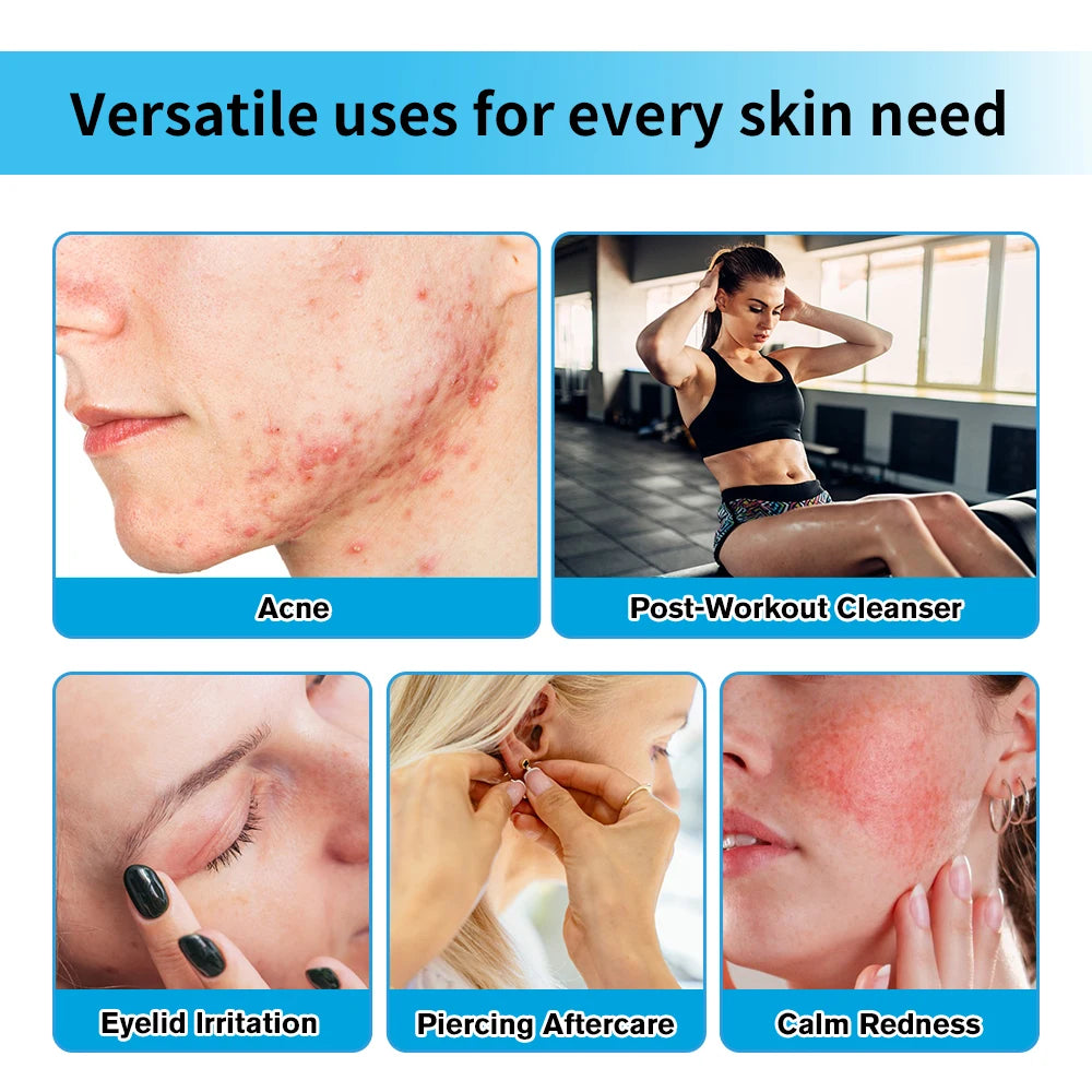 Hypochlorous Acid Soothing Facial Mist for Acne and Redness